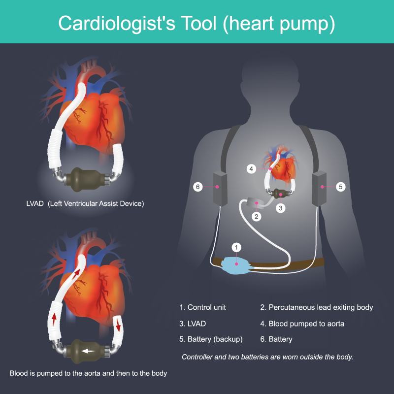 LVAD - Fig 1 - web.png LVAD - Fig 1 - web.png