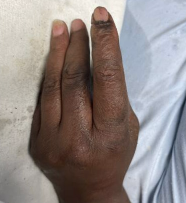 Finger Entrapment - Fig 10.png