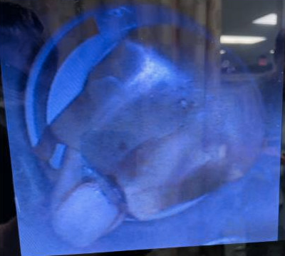 Finger Entrapment - Fig 4.png