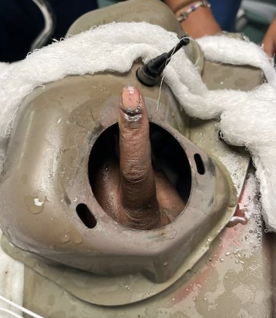Finger Entrapment - Fig 8.png