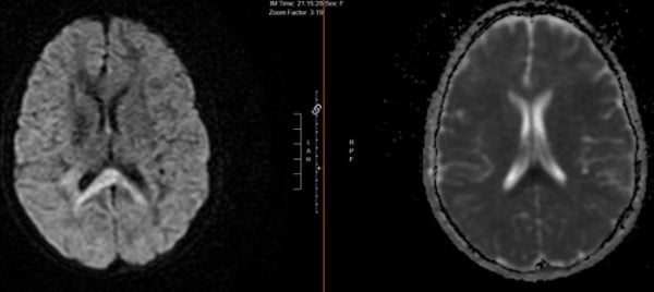 Influenza A - Fig 2 MRI brain.jpg