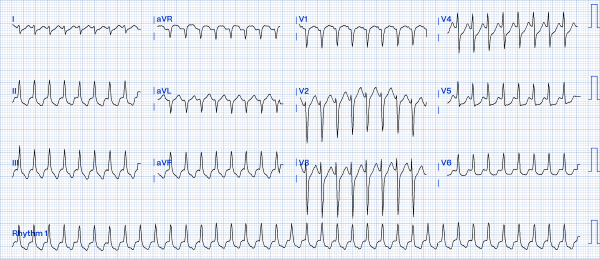 Alcohol-induced Tachycardia - Fig 1.png