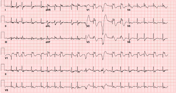 ARVC - ED EKG.png