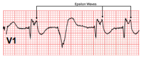 ARVC - epsilon waves.png