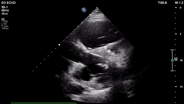 ARVC - psl-gif.gif