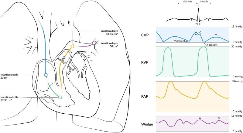Crit Care Device - PAC 2 - Fig 2.jpeg