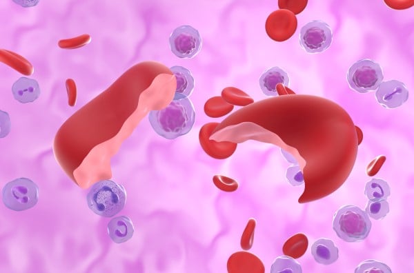 Hemolytic Anemia stock image.jpg