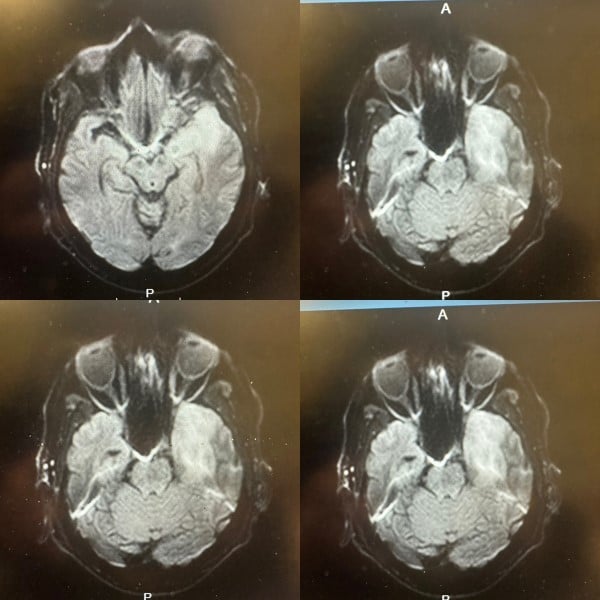 HSV Encephalitis - Image 1.jpg