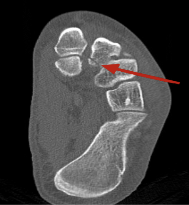 Lisfranc - Fig 1.png