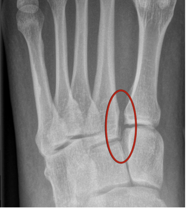 Lisfranc - Fig 2.png
