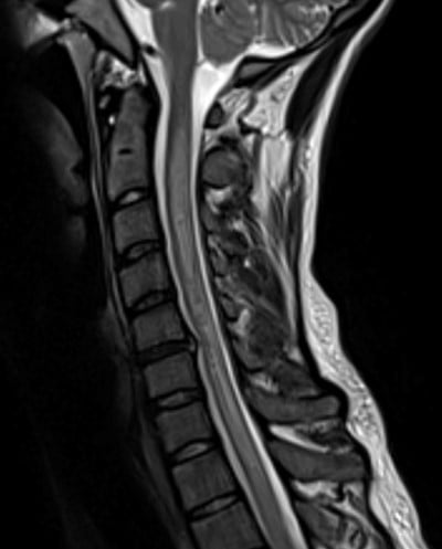 Nitrous Oxide - c-spine-mri.jpg