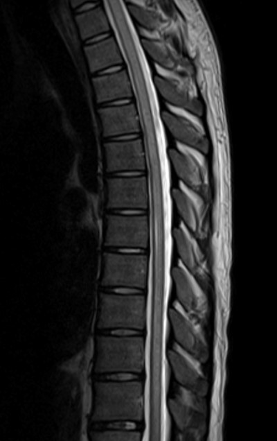 Nitrous Oxide - thoracic-spine-mri.jpg