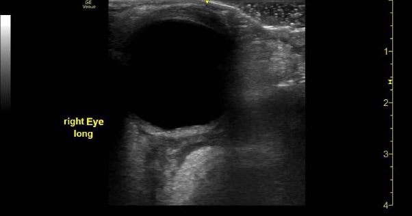 Orbital Cellulitis - Fig 2.jpg