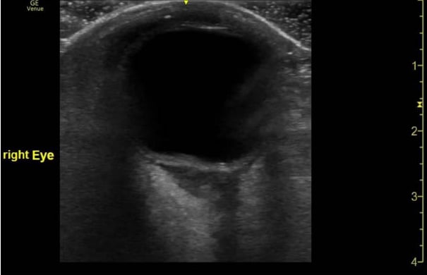 Orbital Cellulitis - Fig 3.jpg