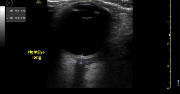 Orbital Cellulitis - Fig 4.jpg