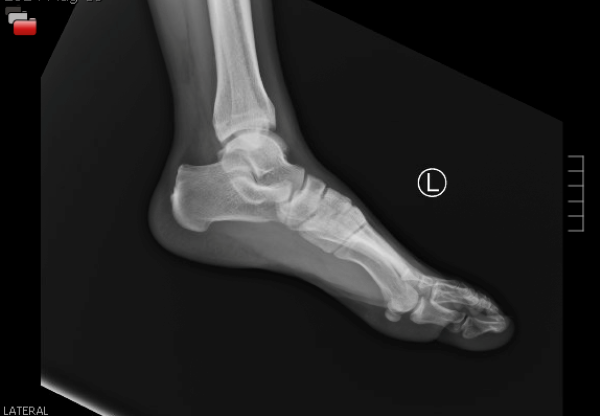 POCUS FTW Achilles Tendon - Image 1.png