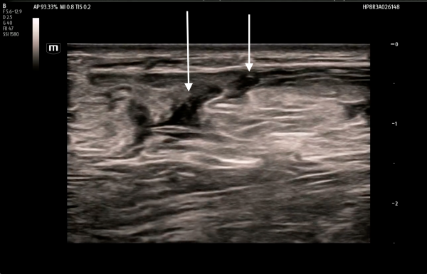 POCUS FTW Achilles Tendon - Image 2.png
