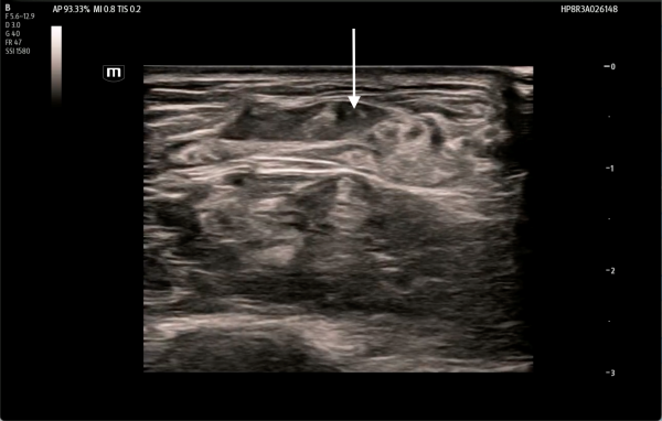 POCUS FTW Achilles Tendon - Image 3.png