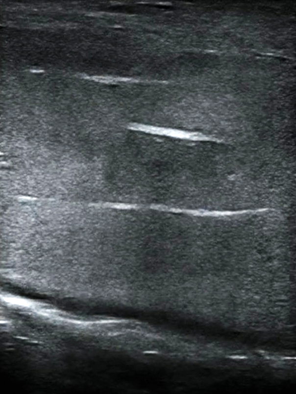 PF - Figure 2. Point-of-care ultrasound of sagittal view showing normal anatomy of corpora cavernosa.png