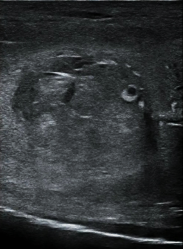 PF - Figure 3. Point-of-care ultrasound of sagittal plane of mid-shaft proximal penis demonstrating hematoma with edge artifact and TA defect..png