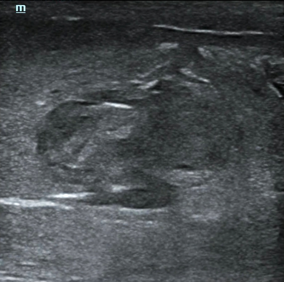 PF - Figure 4. Point-of-care ultrasound of Transverse plane of mid-shaft proximal penis demonstrating hematoma and TA defect..png