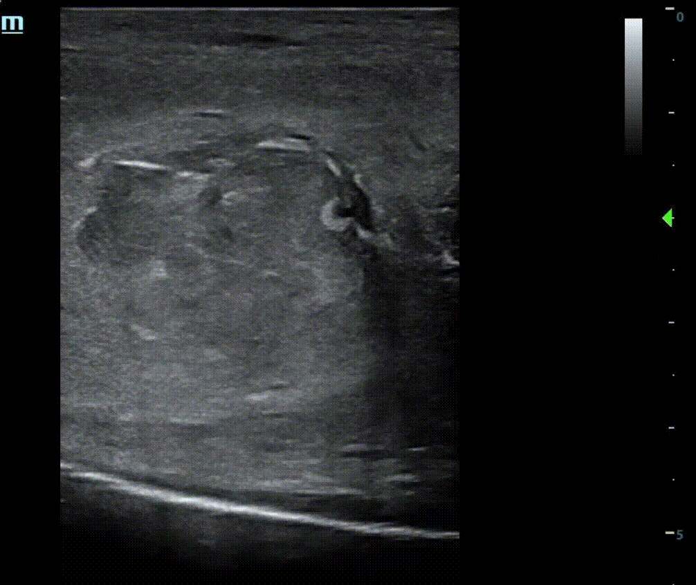 PF - Video 1. Point-of-care ultrasound of sagittal plane demonstrating hematoma with edge artifact and TA defect..gif