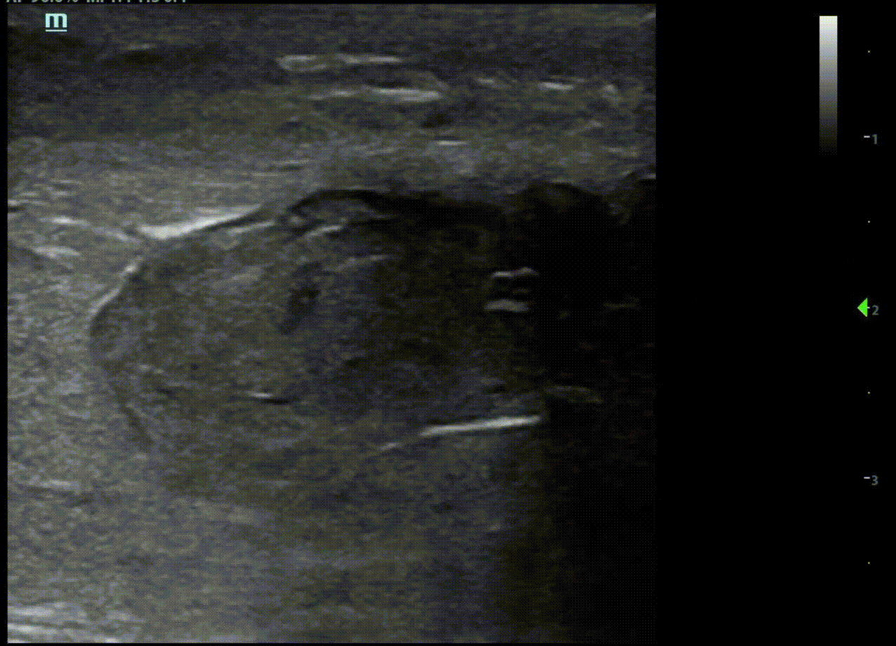 PF - Video 2. Point-of-care ultrasound of Transverse plane demonstrating hematoma and TA defect..gif
