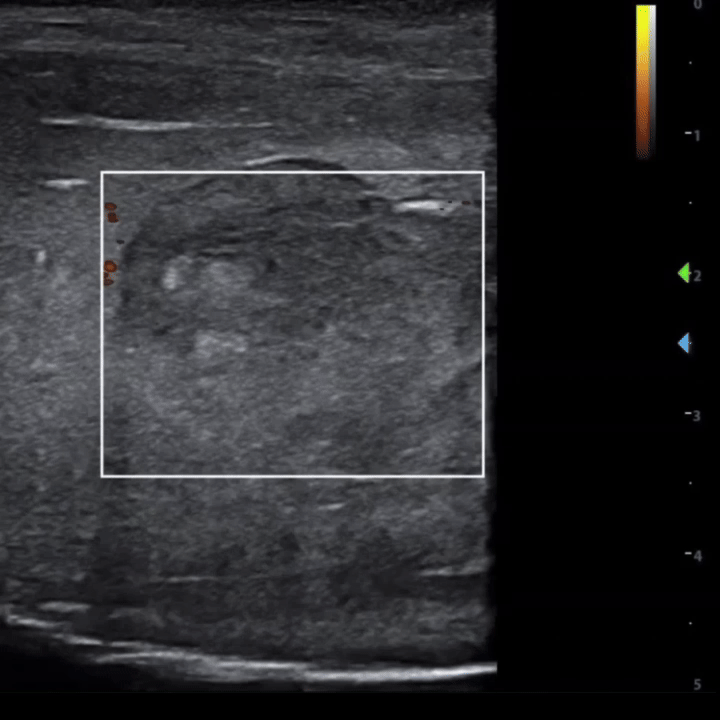 PF - Video 3. Point-of-care ultrasound of Transverse plane in Power Doppler demonstrating lack of flow.gif