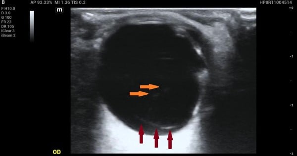 Vitreous Hemorrhage - Image 1.jpg