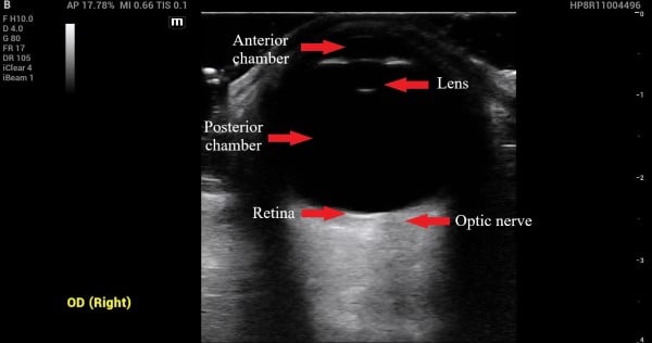 Vitreous Hemorrhage - Image 2.jpg