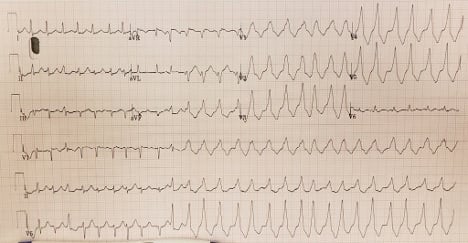 ECG 30 minutes post-treatment 101425-ECG2.jpg