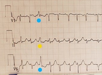 ECG shows slightly wider complex beat demonstrating the classic delta wave pattern of WPW 101425-ECG3.jpg