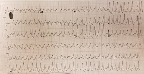 ECG Challenge - AFib with WPW (1).jpg