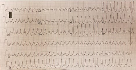 ECG Challenge - AFib with WPW (1).jpg