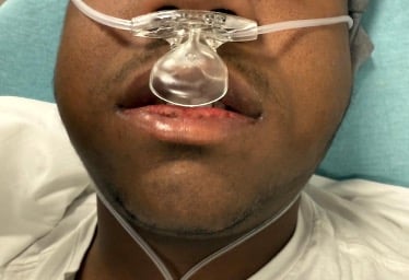 Figure 4: Bilateral buccal edema