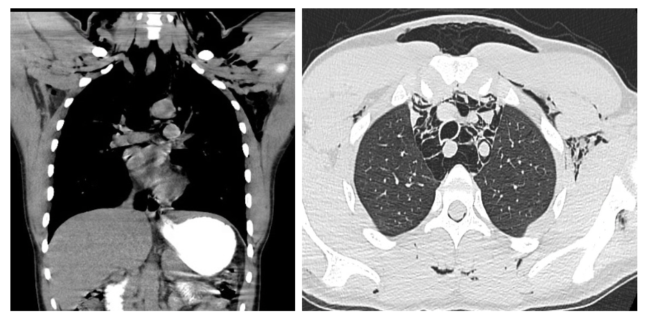 Figure 2,3: CT chest with oral contrast