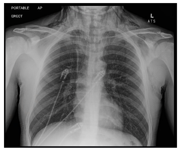 Figure 1: Chest X-Ray
