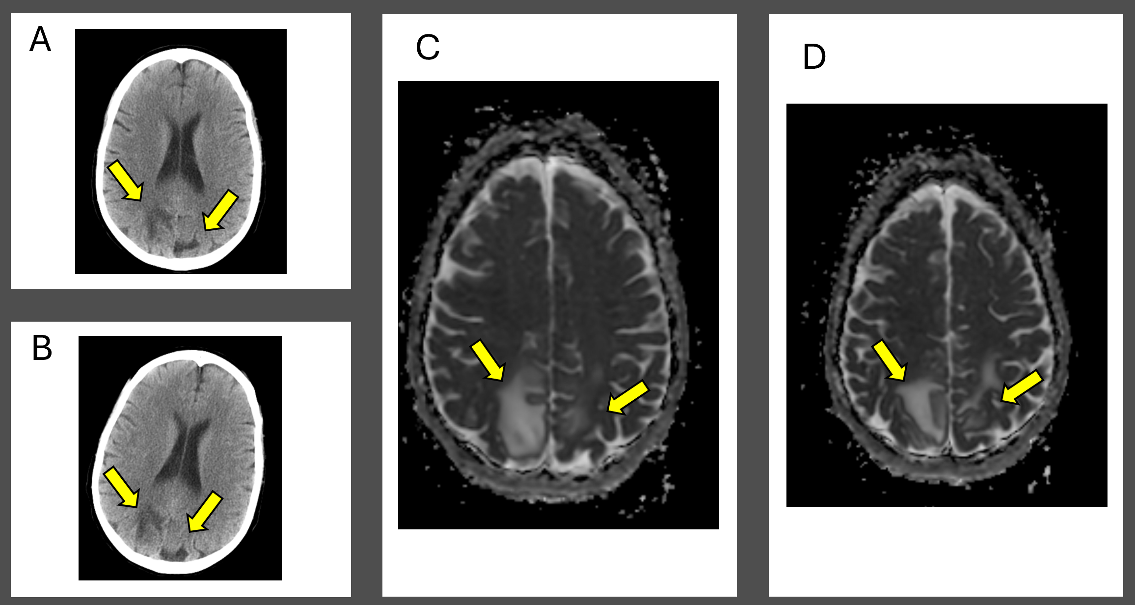 Posterior-Reversible-Encephalopathy-Syndrome-Figures.png