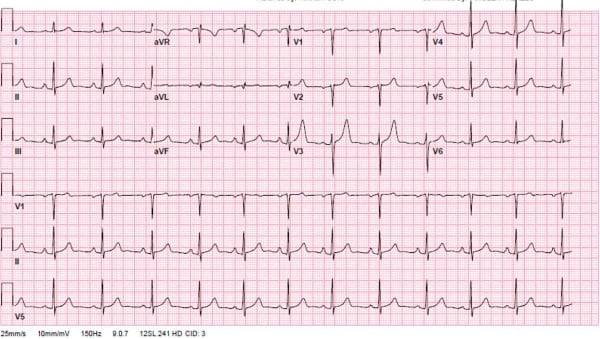 Heart Block Figure 2.jpg
