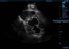 ccus - fractional shortening fig 2a.png