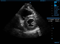 ccus - fractional shortening fig 2b.png