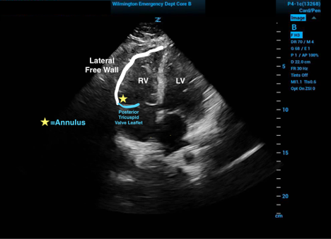 Validation of the Tricuspid Annular Plane Systolic Excursion