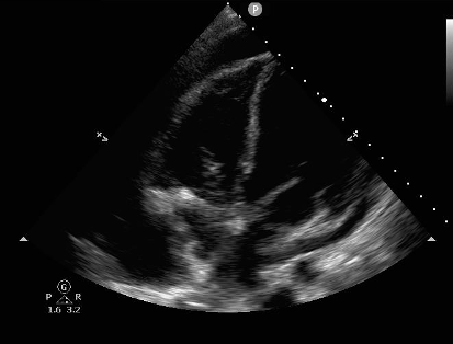 US - Signs of Cardiac Tamponade 1.png