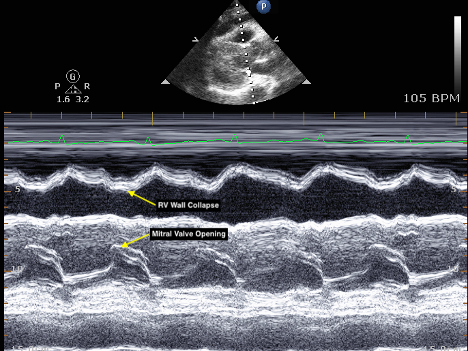 US - Signs of Cardiac Tamponade 2.png