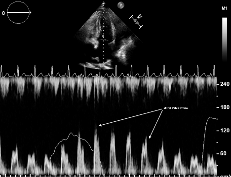 US - Signs of Cardiac Tamponade 3.png