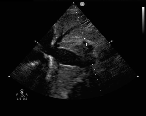 US - Signs of Cardiac Tamponade 4.png