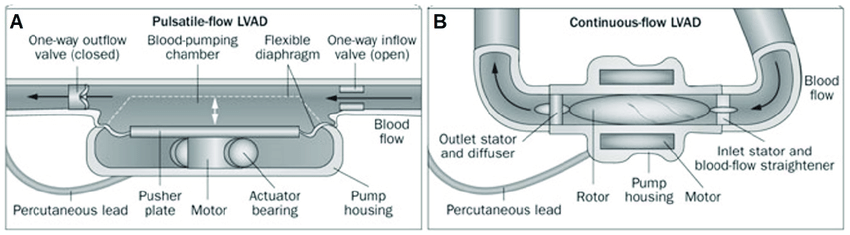 CC Devices - LVAD pulsatile flow.png