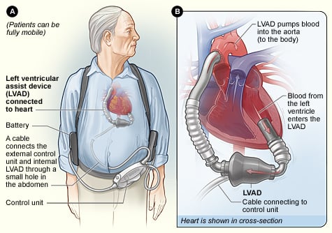 CC Devices - LVAD.jpg