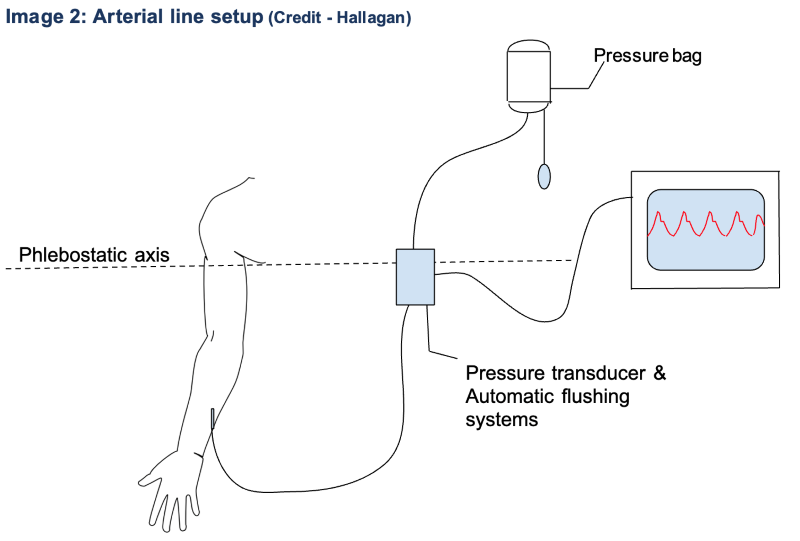 Critical Care Device Series: Arterial Lines Part 2 - Waveforms and ...
