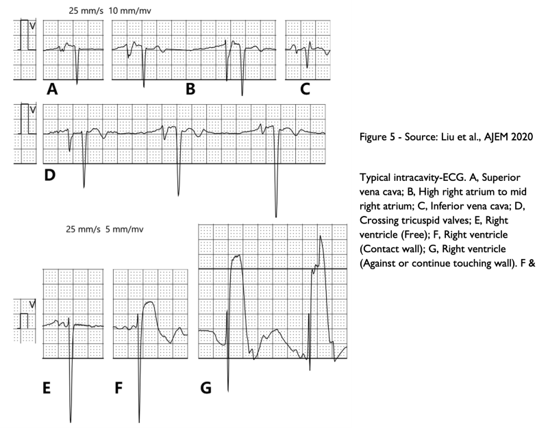 TVP EKGs.png